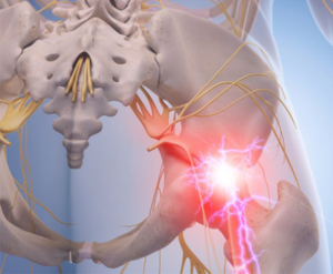Sciatica Pain